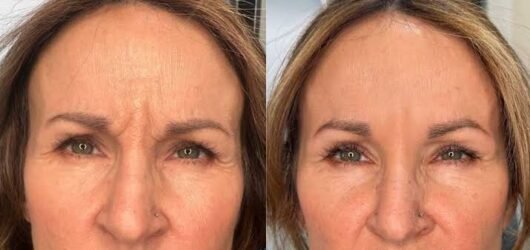 Botox in Fort Myers